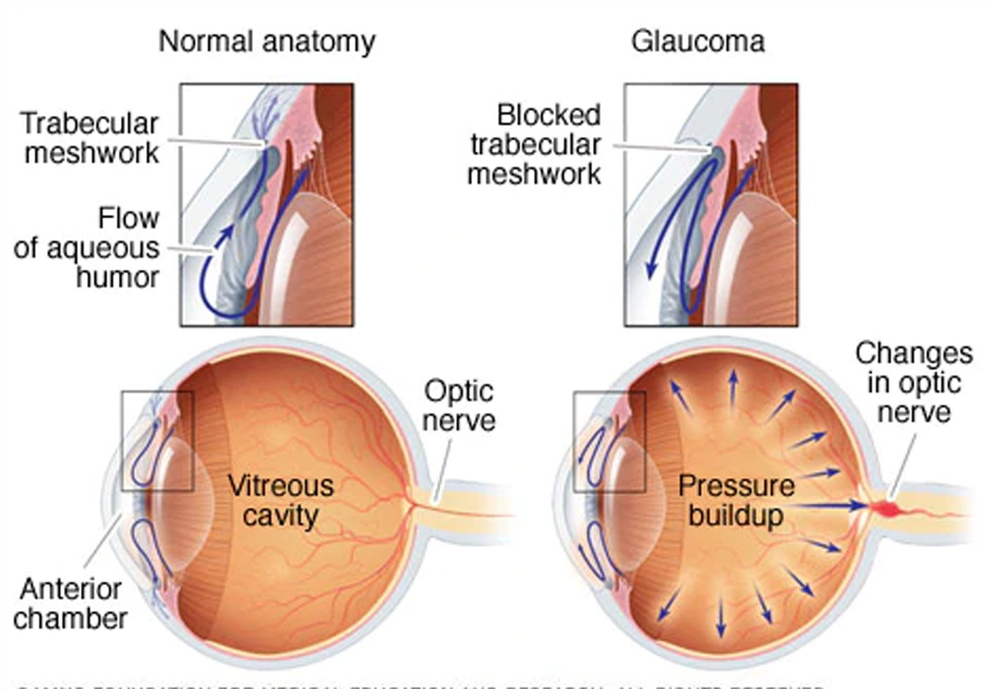 Glaucoma Specialist in Bangalore